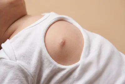 Gros plan sur le torse d'un bébé montrant un petit nodule sous le téton, fond neutre.